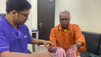 80% जला मरीज हुआ स्वस्थ्य, ओम हॉस्पिटल में ईएसआईसी से हुआ 20 लाख का फ्री इलाज…