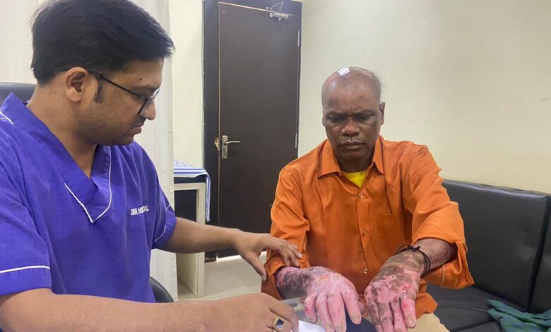 80% जला मरीज हुआ स्वस्थ्य, ओम हॉस्पिटल में ईएसआईसी से हुआ 20 लाख का फ्री इलाज…