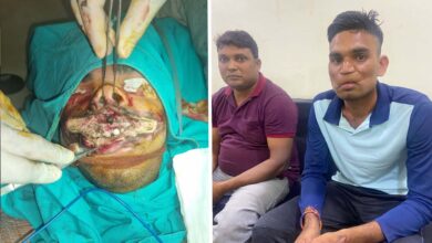 करेंट से झुलस गया युवक का चेहरा, पीठ से मास निकलाकर डॉ कमलेश ने बनाएं होठ