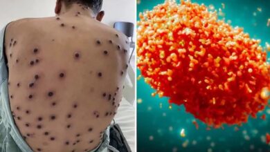 आइसोलेटेड मरीज में पश्चिम अफ़्रीकी क्लैड 2 के एमपॉक्स वायरस की पुष्टि