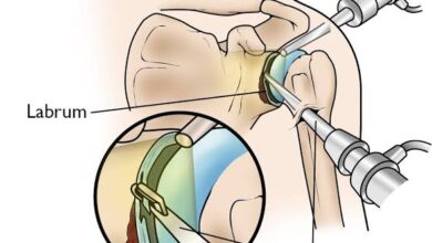 कंधे के बार-बार खिसकने से युवक था परेशान, दूरबीन सर्जरी से एसएमसी सुपर स्पेशलिटी हॉस्पिटल में मिला आराम