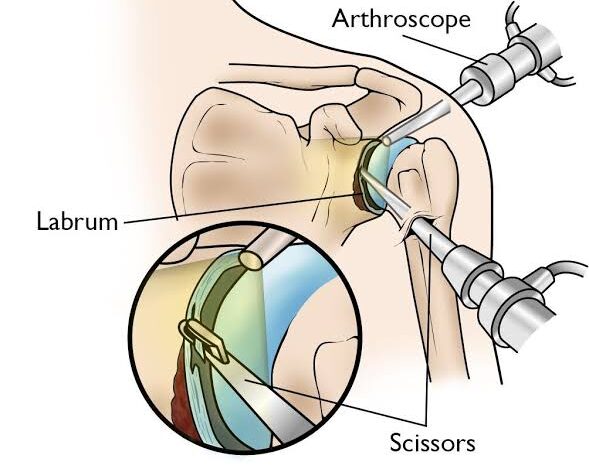 कंधे के बार-बार खिसकने से युवक था परेशान, दूरबीन सर्जरी से एसएमसी सुपर स्पेशलिटी हॉस्पिटल में मिला आराम
