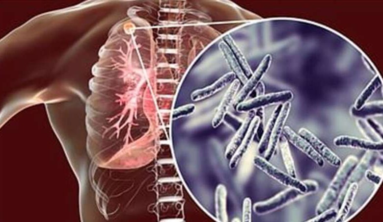 टीबी से मौत रोकने के लिए तमिलनाडु सरकार की नई रणनीति कारगर टीबी से मौत रोकने के लिए तमिलनाडु सरकार की नई रणनीति कारगर